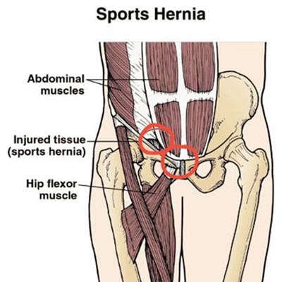 Sports Hernia - Cause, Symptoms, Treatment